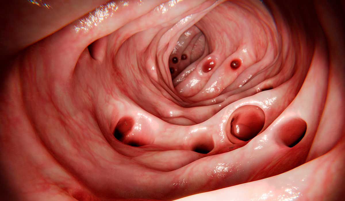 Diverticulitis 